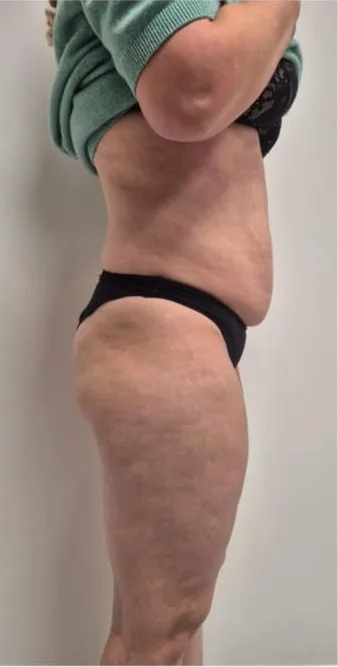 Po procedūrų